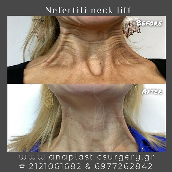 Nefertiti Neck Lift